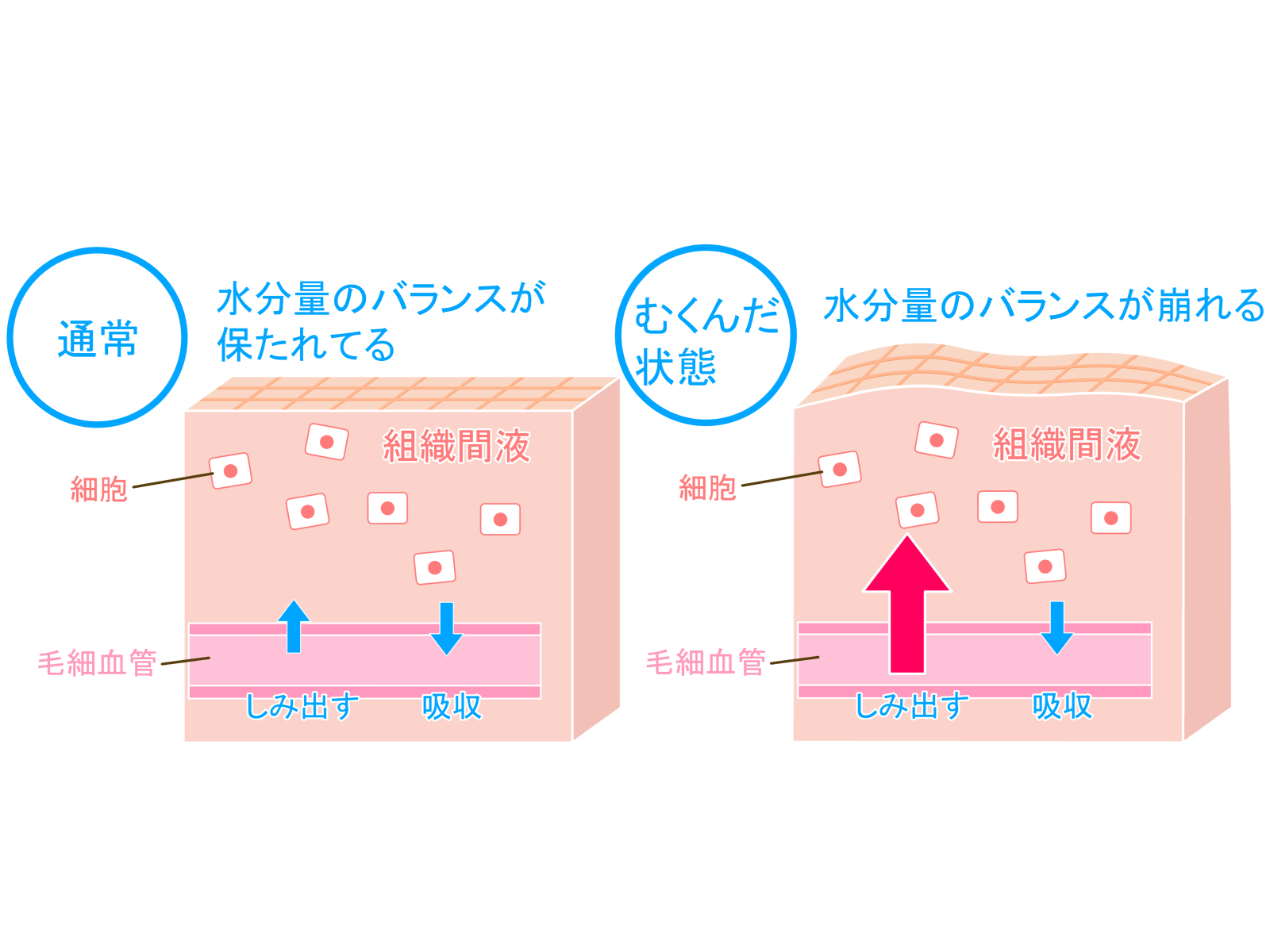 リンパ浮腫の危険因子は何ですか?